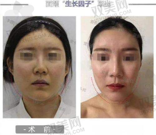 五、玻尿酸填充的维持时间