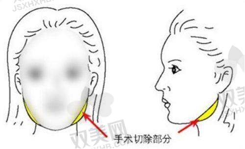 了解去颈纹手术
