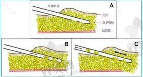 润致玻尿酸成效如何