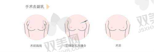注射过程