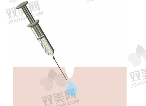 三、玻尿酸填充过程