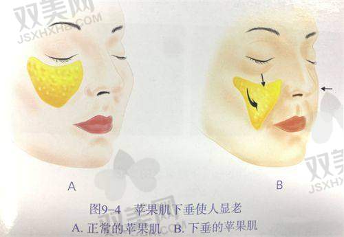 润致玻尿酸能维持多久