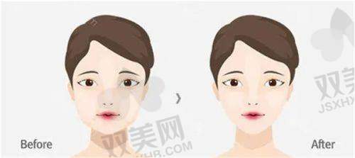润致玻尿酸适合哪些人群