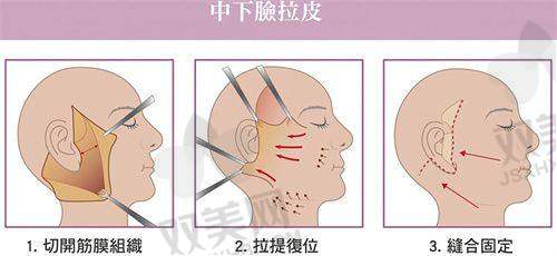 伊维兰5D童颜针与瑞博对比