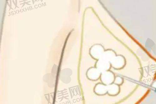 【梅州曙光医疗美容医院地址及乘车路线】