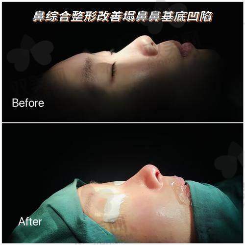 深圳本地做鼻子，为什么一定要考虑张辉？