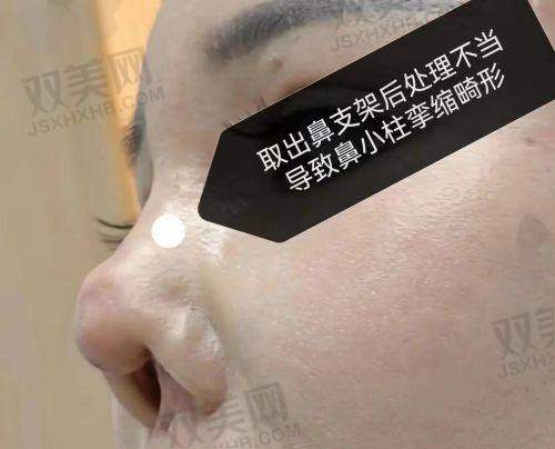 总结：张辉医生，良心鼻整的代表选手！