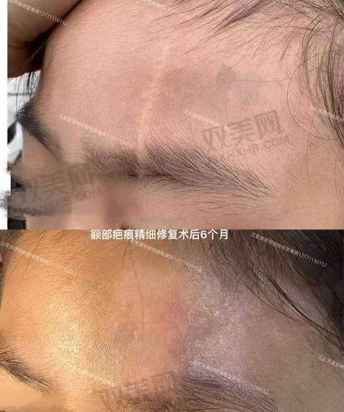 激光几次能长平
