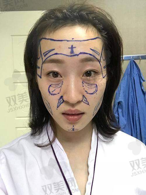 如何降低脸部填充的风险