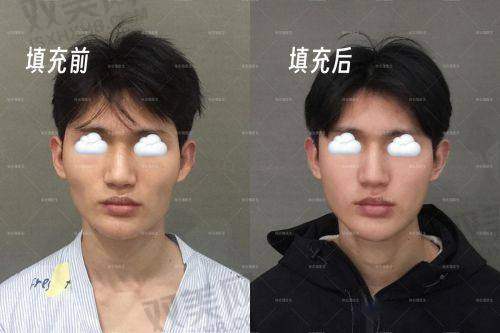 脸部填充的成效评估