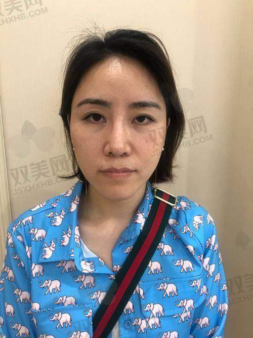 脸部填充的适用人群和不适用人群