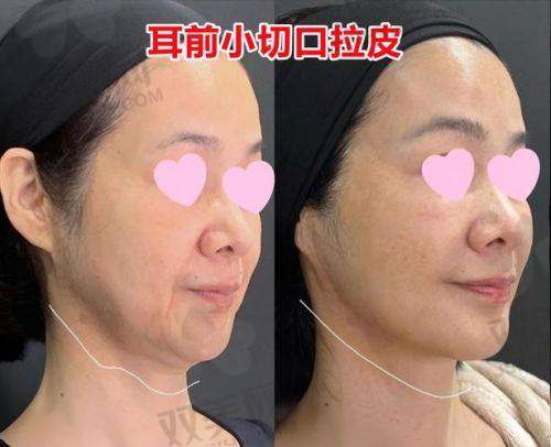 百科君碎嘴时间：关于“拉皮失败”的那些坑，快记录！