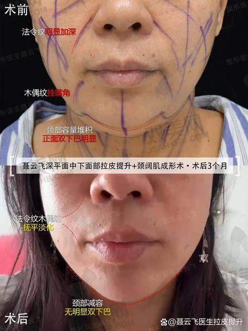 震惊！天津美莱王广隐藏式筋膜提升术，作用骨膜深层紧致，5W 起焕新面部轮廓！