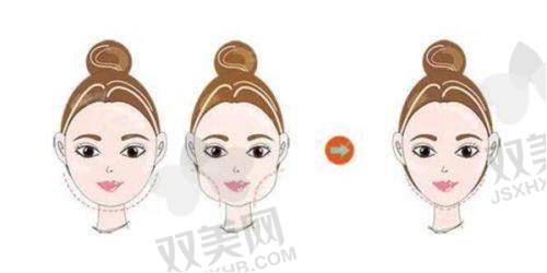 2025厦门蓓蕾斯特整形医院贵吗？蛋白线提拉3990起，乳房矫正2万+