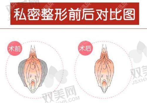 如何选择合适的手术方式