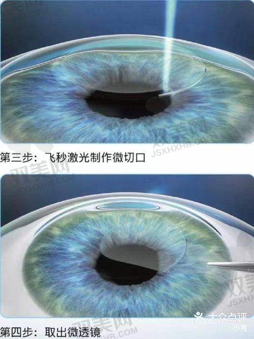 做完手术的人都怎么说？可别听我一个人吹厉害，来看看真实用户反馈！