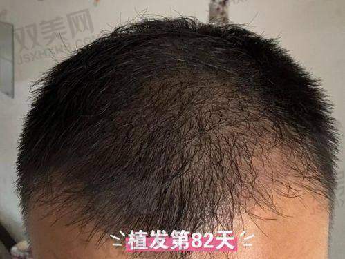 i黑密生发头盔和其他生发产品对比如何