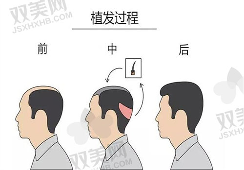 揭秘意大利蛋白纤维植发：效果、价格、持久性全解析