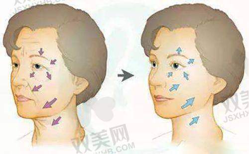 注射玻尿酸丰胸全过程解析