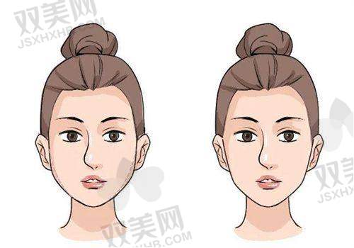 填充面部填充的术前注意事项有哪些？