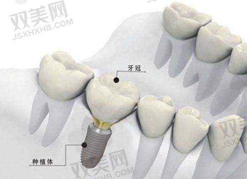 与其他全口义齿材料的对比