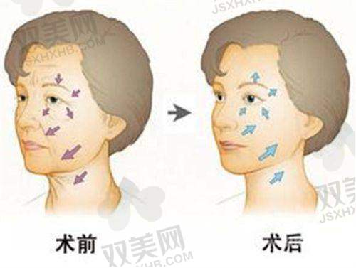 多次填充可延长成效