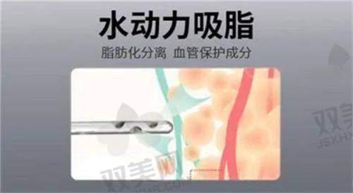 医美瘦脸法之面部吸脂