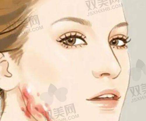 影响玻尿酸溶解时间的因素