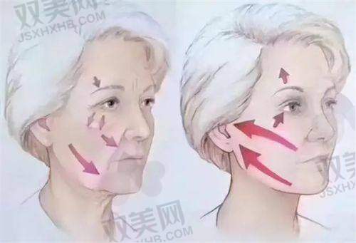 如何选择适合自己的玻尿酸