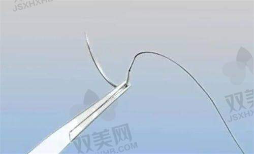 不同医院资质下沈阳眼袋切除术价格情况