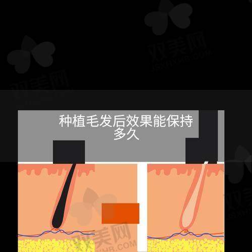 意大利蛋白纤维植发的劣势是什么