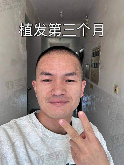 意大利蛋白纤维植发后要怎么护理
