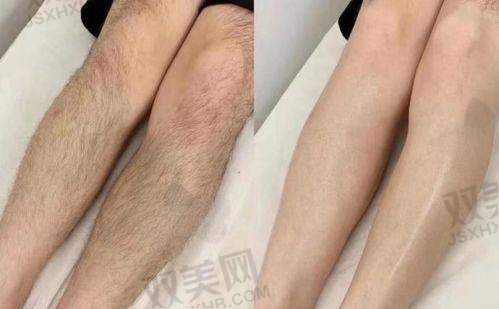 医美改善发缝变宽的方法