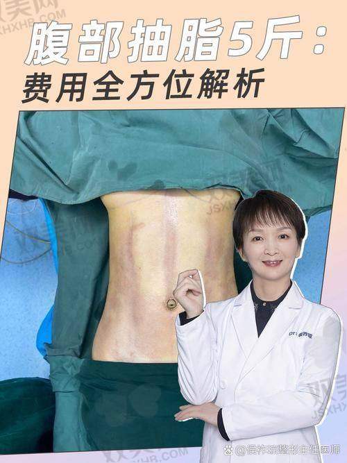重庆腹壁成型真人实例 | 小红书博主“小卷卷”的术后180天记录