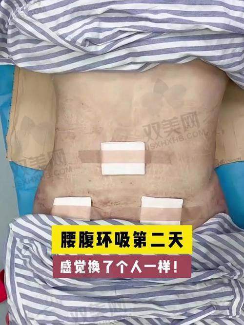 什么人适合做腹壁成型？你看看你中招没！