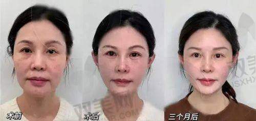 术后肿胀期