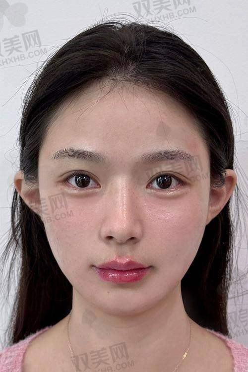 法令纹的烦恼