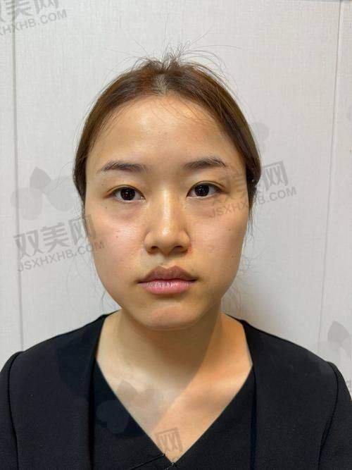 下定决心去填充下巴