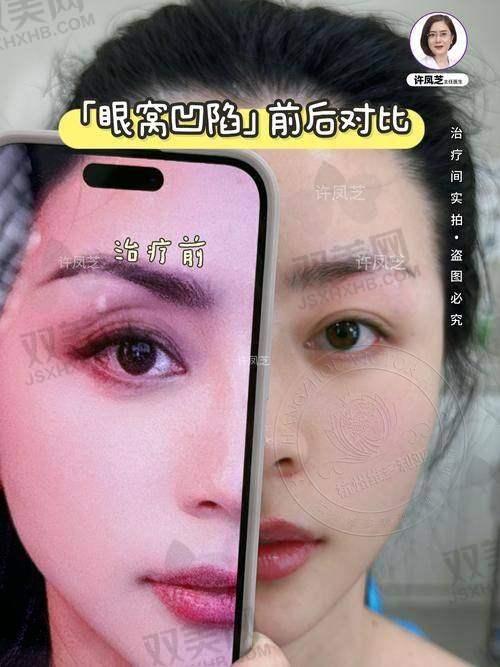 瘦脸针瘦脸的过程是怎样的
