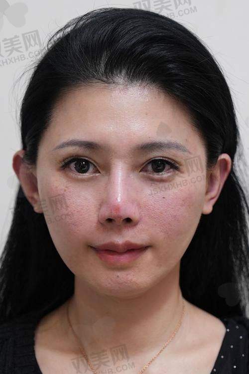 面部填充术一般要多少钱？