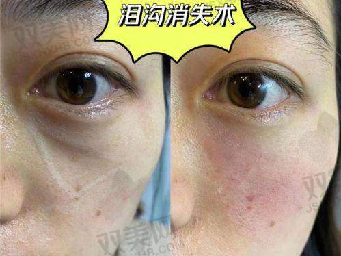 面部填充术后如何护理？