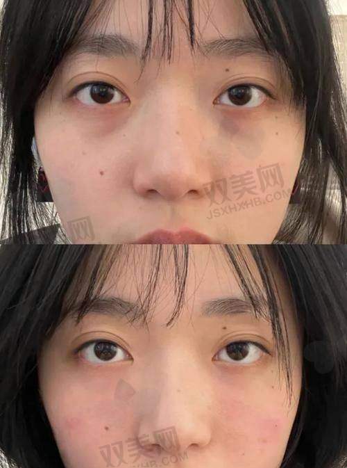 面部填充术有危害吗？
