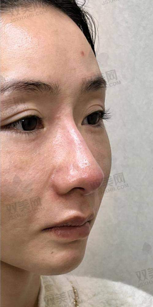 面部填充术会有后遗症吗？