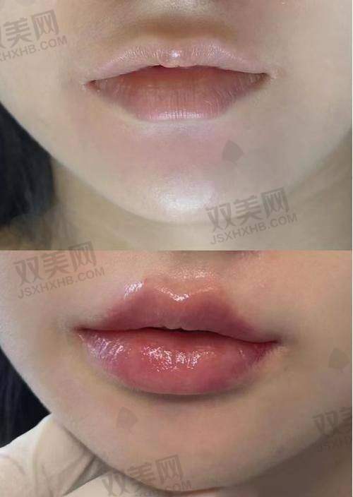瘦脸针瘦脸的价格是多少