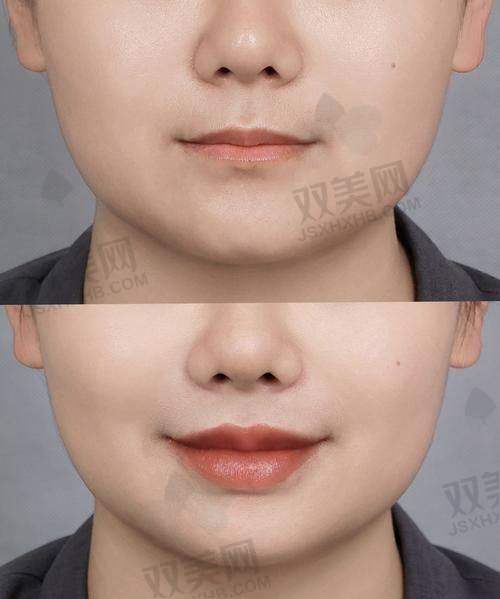 瘦脸针瘦脸的成效如何