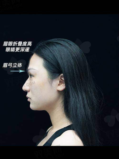 法令纹——我的“心头大患”