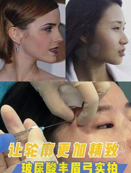 瘦脸针瘦脸的原理是什么