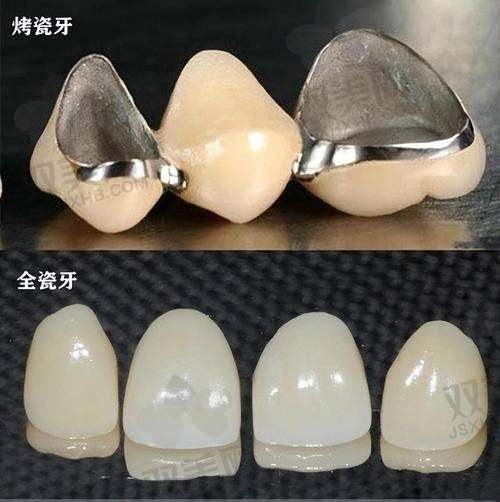 泽康全瓷牙的出色性能