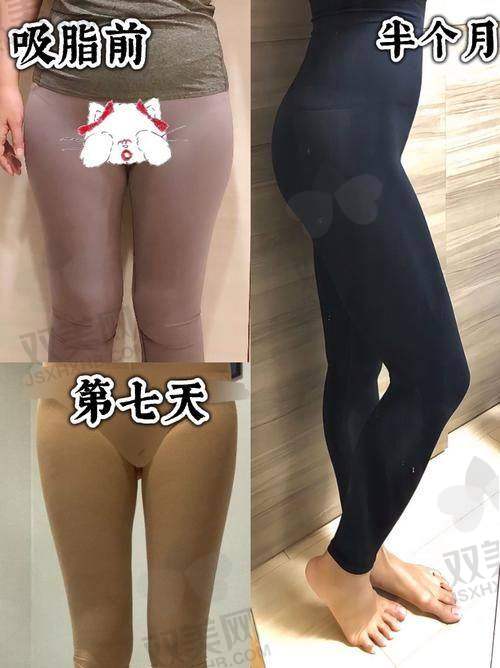 六、避坑指南：直腿术那些你想不到的隐藏费用？西美少套路多惊喜！