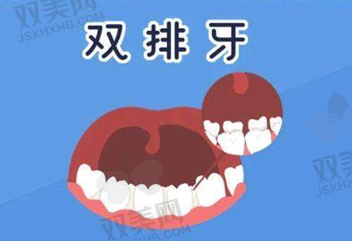 四、老司机进阶版：全口种植牙价格一条龙